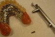 11 klikgebit prothese met schroeven